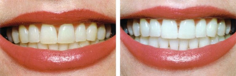 Before and after professional teeth whitening treatment at Templehall Dental Practice